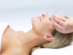 accupuncture headache relief vancouver 