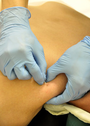 Intra muscular stimulation dry needling